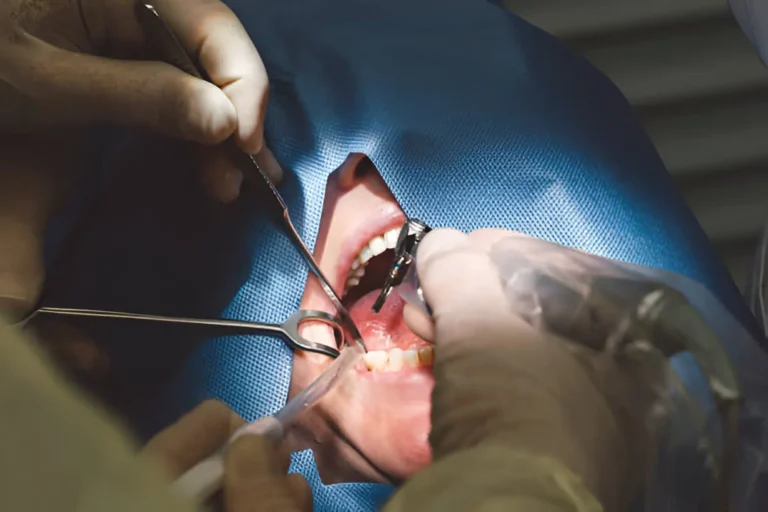 Restoring Smiles with Confidence: The Power of All-on-4 Implants and Expert Oral Surgery
